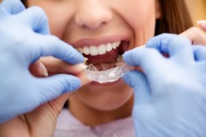 Invisalign in Sheffield