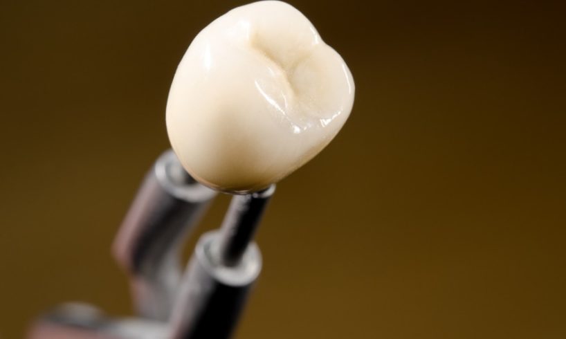 Reasons For Getting Dental Implants Overseas