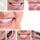 Simple Solutions To Straighten Teeth