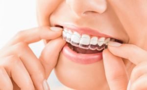 Advantage of having a removable aligner