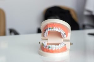 Advantages Of A Dental Implant