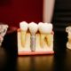 The Advantages Of A Dental Implant