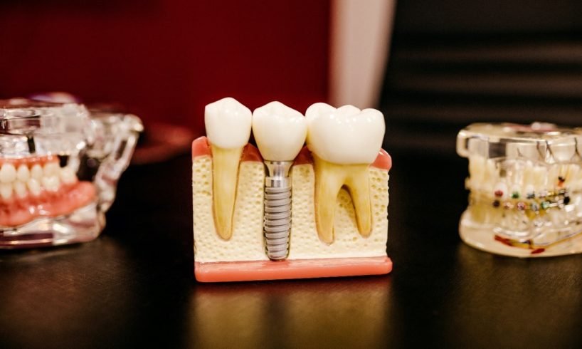 The Advantages Of A Dental Implant