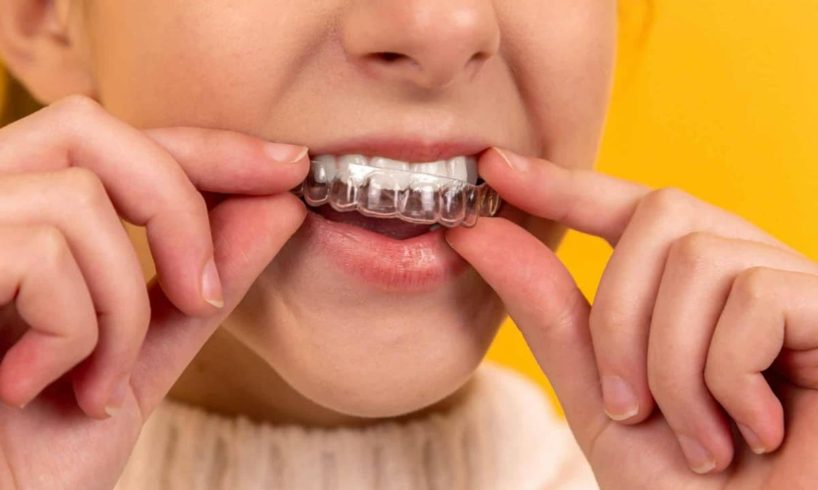 Advantages Of Wearing An Invisible Aligner